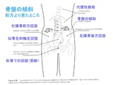 右腸骨の前方回旋