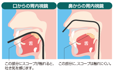 胃カメラ口と鼻