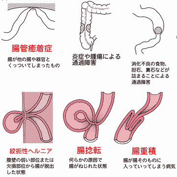 腸閉塞にも、さまざまな種類があるようです