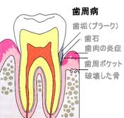 teeth_sisyubyou