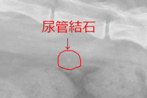 尿管結石