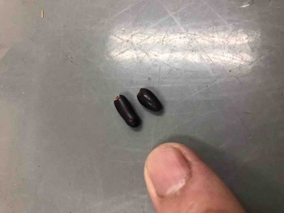 腎結石・尿管結石