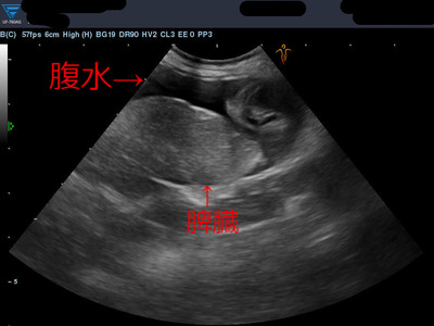 腹水エコー