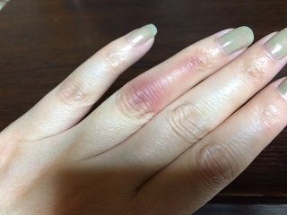 やけど?