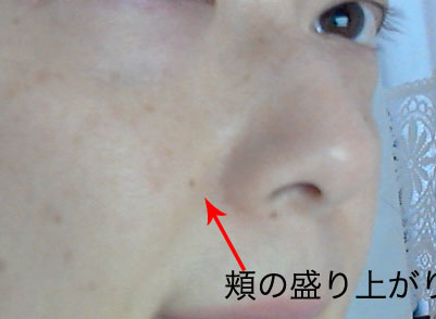 頬の盛り上がり