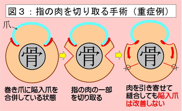 指の肉を切り取る手術1-3
