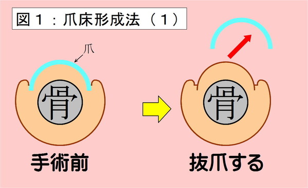 爪床形成法-01