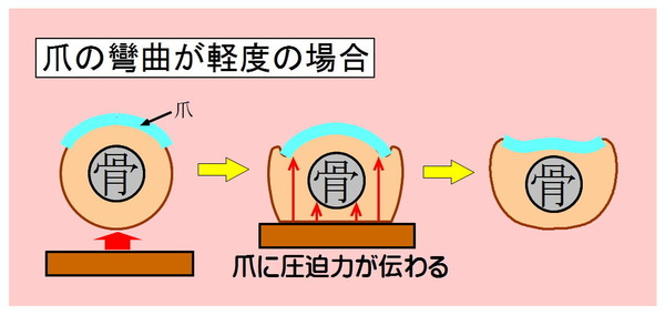 巻き爪-01