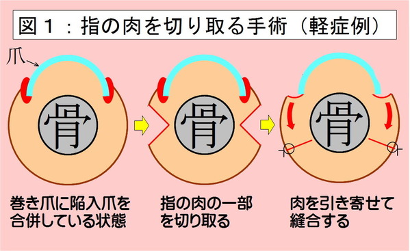 指の肉を切り取る手術1-1