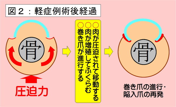指の肉を切り取る手術1-2