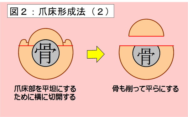 爪床形成法-02