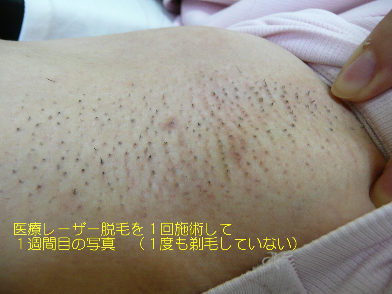 生えたて脇毛 の掲示板投稿写真＆画像
