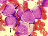 126_leukemia.jpg