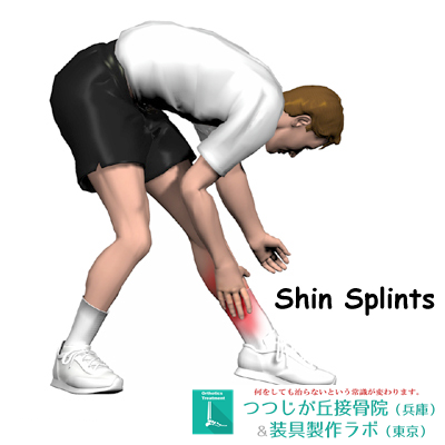 シンスプリントは骨の痛み