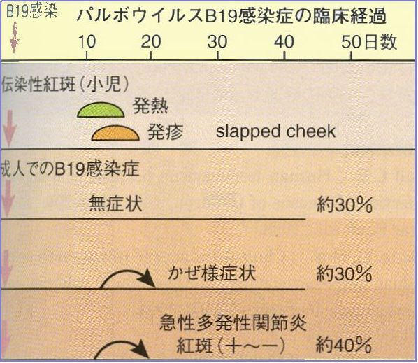 おとなでは無症状の経過あるいは関節痛など関節炎の病態をとることが普通です。妊婦さん・遺伝性の貧血を持っている患者さんは胎児水腫・重症貧血の可能性があり要注意