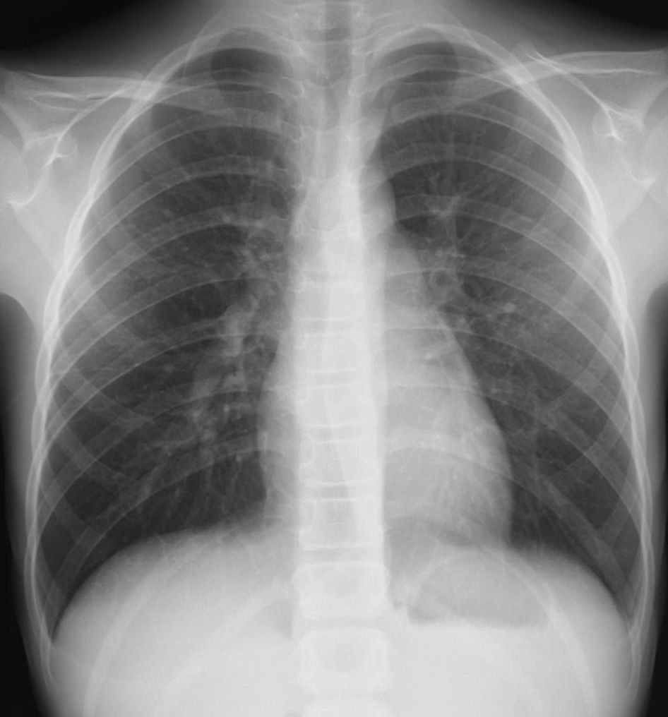 こどもの病気・おとなの病気ウイルス性肺炎(インフルエンザB?)