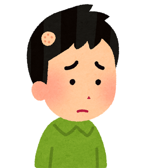 ハゲ