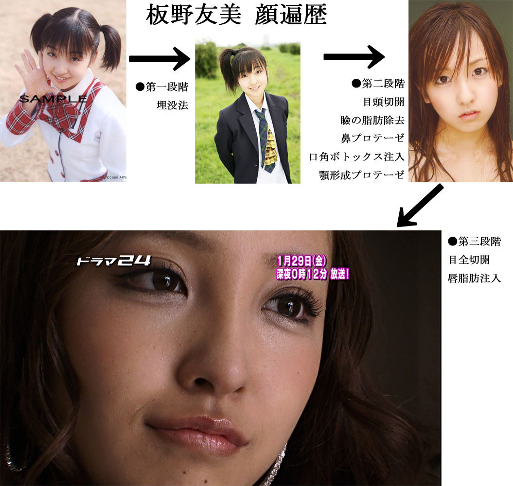 板野 友美 整形