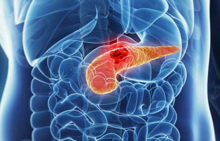 pancreatitis