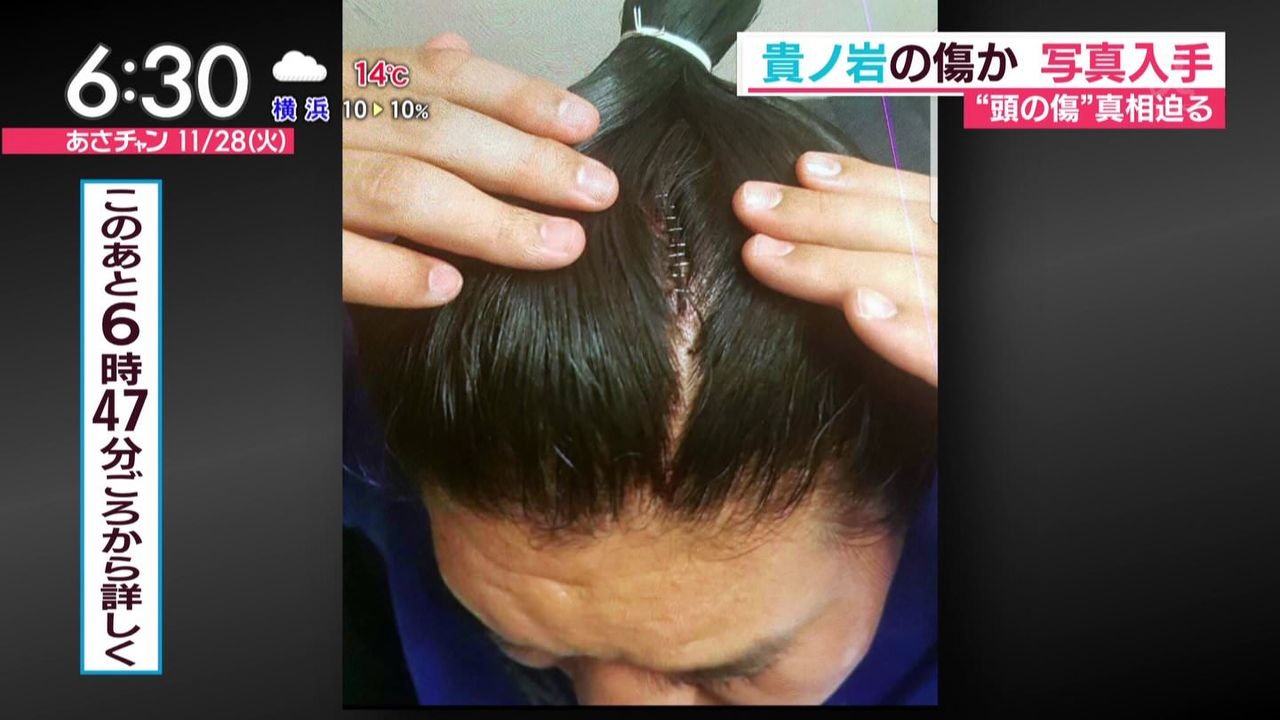 laceration to scalp