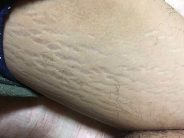 画像 ワイの太もも裏の肉割れやばない にちゃんまとめ