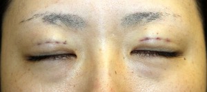 術直後目アップ閉瞼