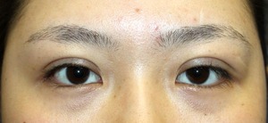 術直後