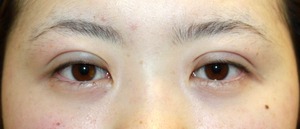 術直後目もと