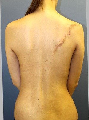 po2Mタトゥー除去背中