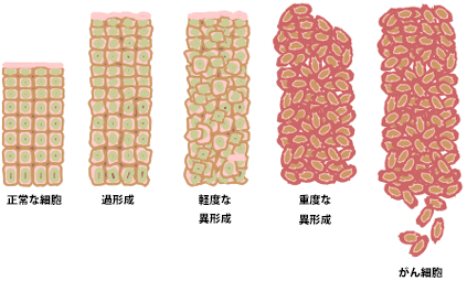 Cancer_progression_from_NIH_japanese