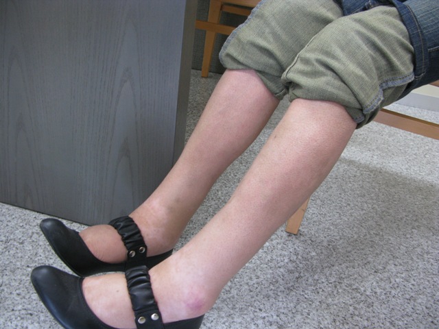 漢方薬服用後2010年6月7日足の浮腫み4
