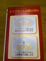 インプラント