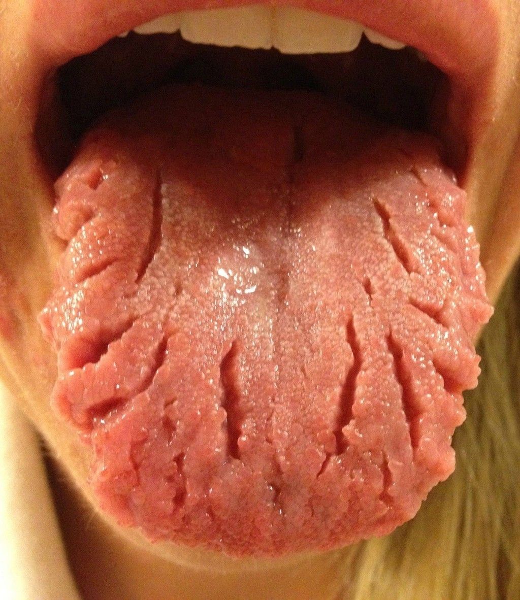 Trichomycosis (Trichobacteriosis): Clinical and ...