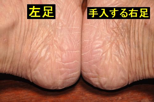 写真は実験開始前の私のかかと