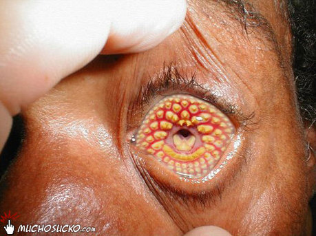 Lamprey-Disease