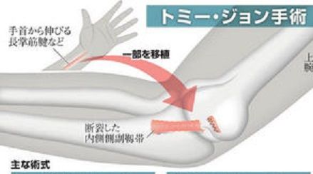 トミー・ジョン手術2
