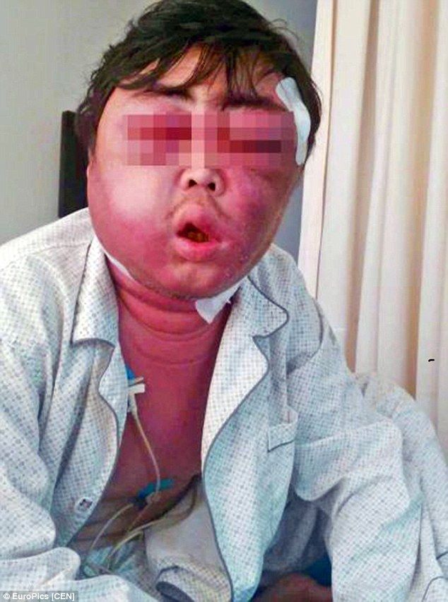 30歳男性、蚊に刺されて顔がパンパンに(画像あり) 2ch「蚊が運んできた何か」「蚊が何かを媒介したな」「中国だから最後は爆発だろ」