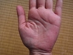 掌蹠膿疱症ビオチン効果の手100410-hidari