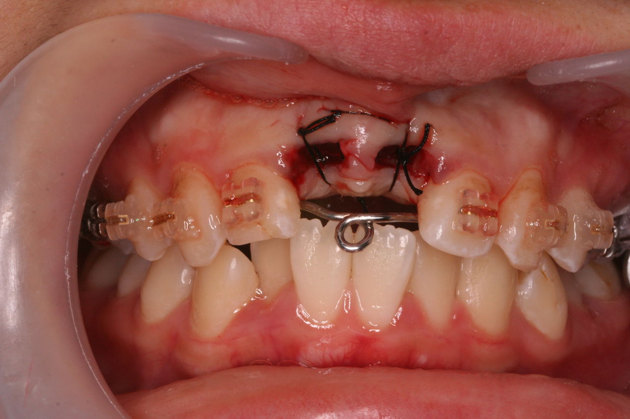 歯 の 矯正 フェラ