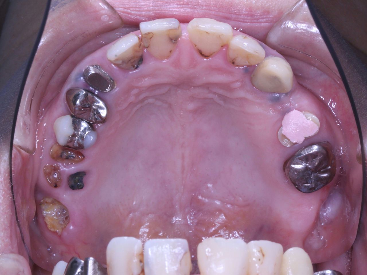 【虫歯 治療】多数歯の虫歯、欠損を伴う40代後半女性⓶