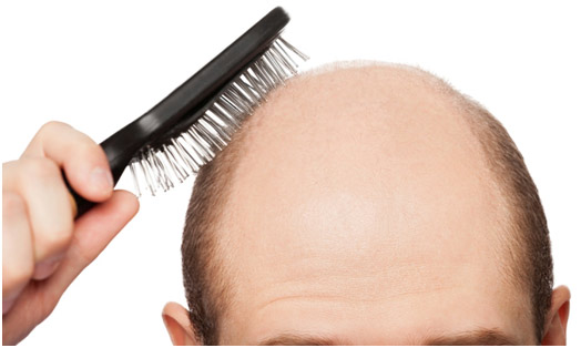 treat-baldness-naturally