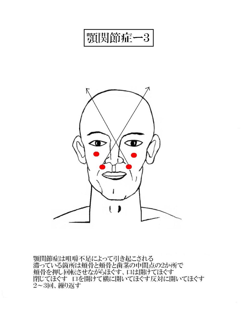 顎関節症-3