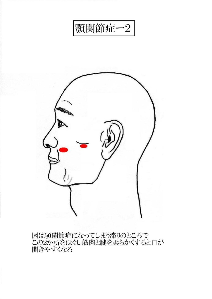 顎関節症-2