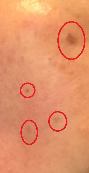 シミ画像あり 肌のシミクリーム Noko を三ヶ月試した結果を公開 Rinのシンプルライフ Powered By ライブドアブログ