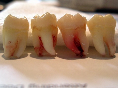 Wisdom-Tooth-Extraction
