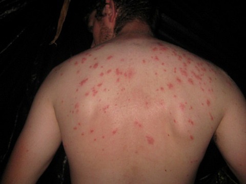 12-bed-bug-bite1