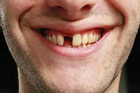 Missing-Anterior-Tooth