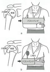 上腕骨近位端部骨折の固定
