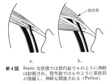 股関節の肢位と梨状筋との関係