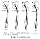 坐骨神経分岐の高位